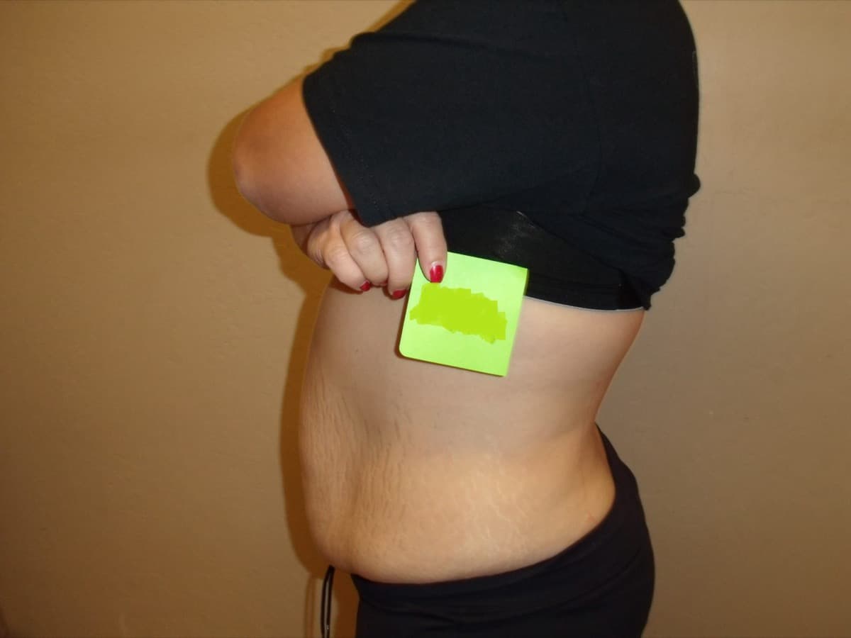 The same patient's abdomen after six laser lipo sessions over two weeks.