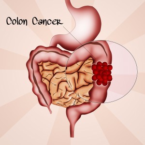 probiotics and colon cancer