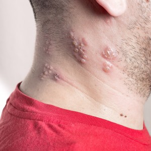 shingles and chikcen pox vaccination