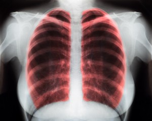 Pneumonia and antibiotics